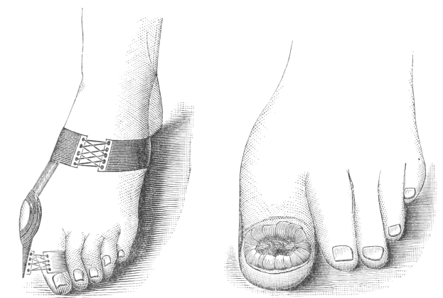 Schwarze und weiße Zeichnung von einem Paar Füße, einer mit einem Verband und der andere mit einer Fraktur, mit Text unten.