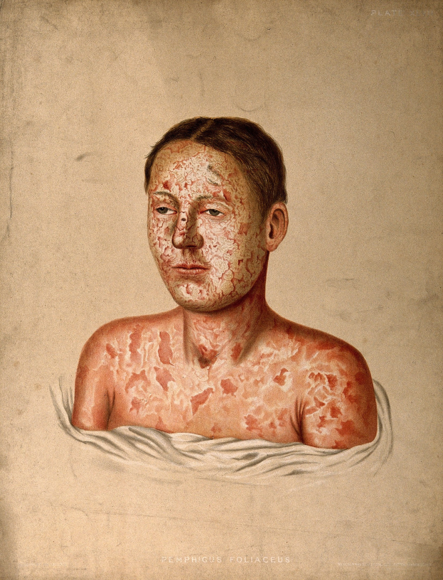 Das Bild zeigt einen Mann mit roten Flecken im Gesicht und auf der Brust, was eine Darstellung der Haut des Mannes darstellt. Der Text unten auf dem Bild betont diesen Begriff weiter und legt nahe, dass der Mann an Hautkrebs leidet.